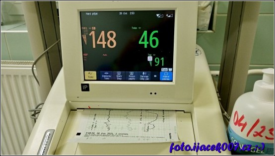 přístroj na monitoring plodu takzvaných ozev.  